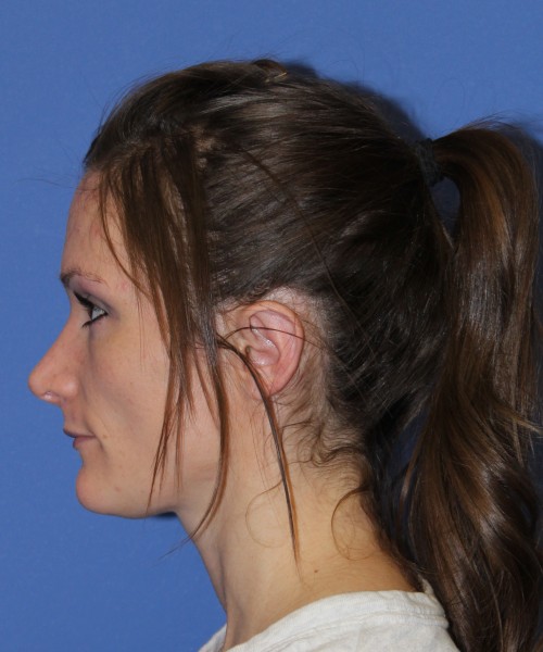Rhinoplasty and Otoplasty 2213 – Click HERE for more views after photo. Individual results may vary.