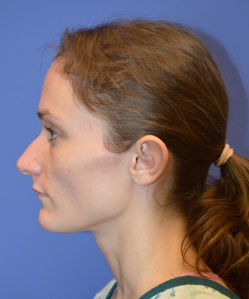 Rhinoplasty and Otoplasty 2213 – Click HERE for more views before photo. Individual results may vary.
