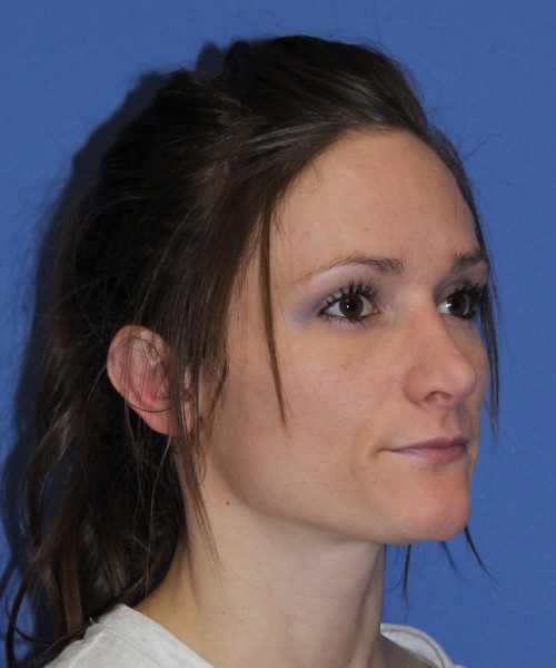 Rhinoplasty and Otoplasty 2213 – Click HERE for more views after photo. Individual results may vary.