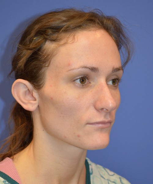 Rhinoplasty and Otoplasty 2213 – Click HERE for more views before photo. Individual results may vary.