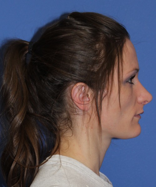 Rhinoplasty and Otoplasty 2213 – Click HERE for more views after photo. Individual results may vary.