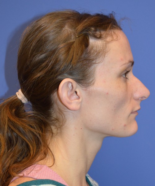 Rhinoplasty and Otoplasty 2213 – Click HERE for more views before photo. Individual results may vary.