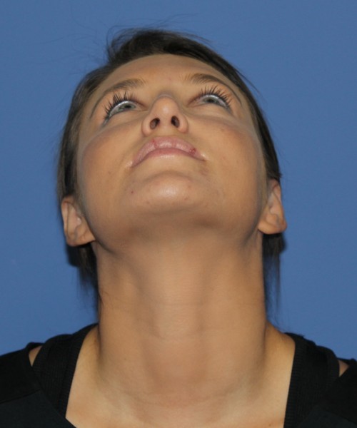 Rhinoplasty and Otoplasty 2227 – Click HERE for more views after photo. Individual results may vary.