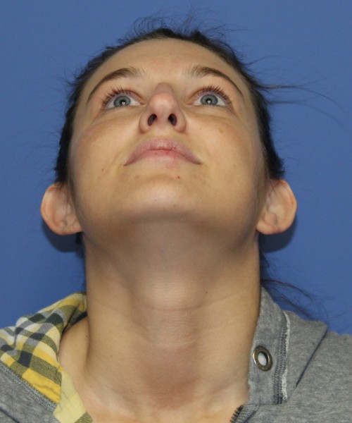 Rhinoplasty and Otoplasty 2227 – Click HERE for more views before photo. Individual results may vary.