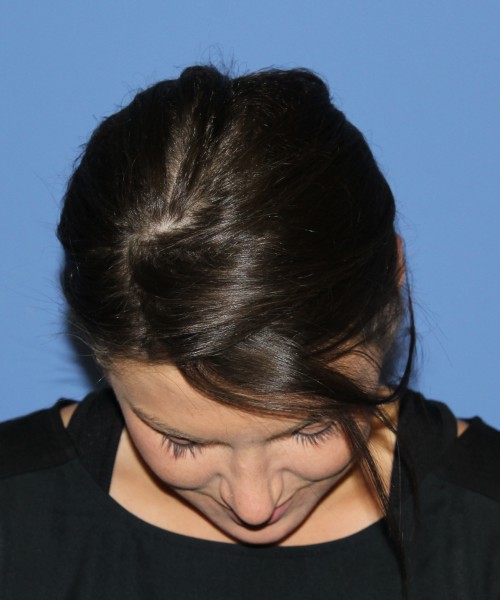 Rhinoplasty and Otoplasty 2227 – Click HERE for more views after photo. Individual results may vary.