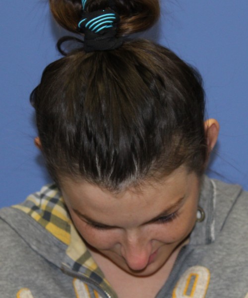 Rhinoplasty and Otoplasty 2227 – Click HERE for more views before photo. Individual results may vary.