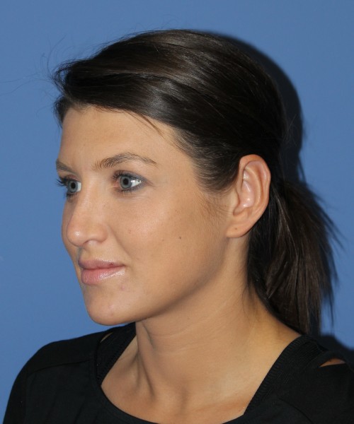 Rhinoplasty and Otoplasty 2227 – Click HERE for more views after photo. Individual results may vary.