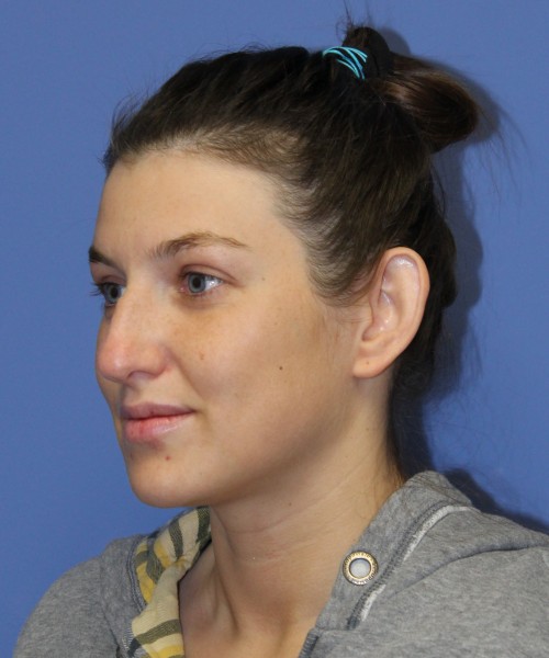 Rhinoplasty and Otoplasty 2227 – Click HERE for more views before photo. Individual results may vary.