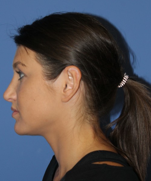 Rhinoplasty and Otoplasty 2227 – Click HERE for more views after photo. Individual results may vary.