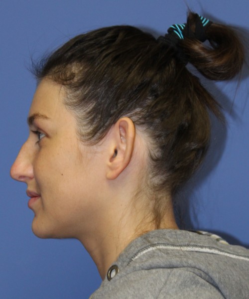 Rhinoplasty and Otoplasty 2227 – Click HERE for more views before photo. Individual results may vary.