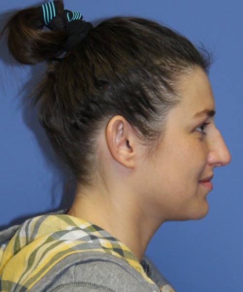Rhinoplasty and Otoplasty 2227 – Click HERE for more views before photo. Individual results may vary.