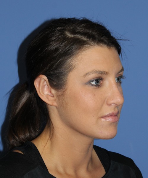 Rhinoplasty and Otoplasty 2227 – Click HERE for more views after photo. Individual results may vary.
