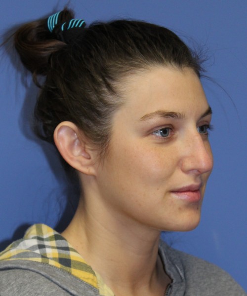 Rhinoplasty and Otoplasty 2227 – Click HERE for more views before photo. Individual results may vary.