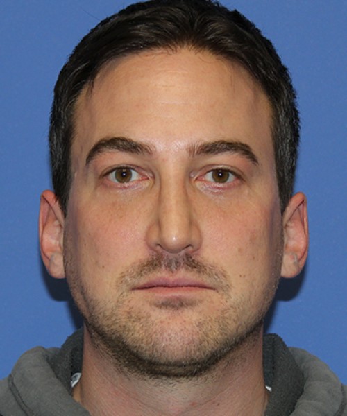Rhinoplasty 2277 – Click HERE for more views after photo. Individual results may vary.