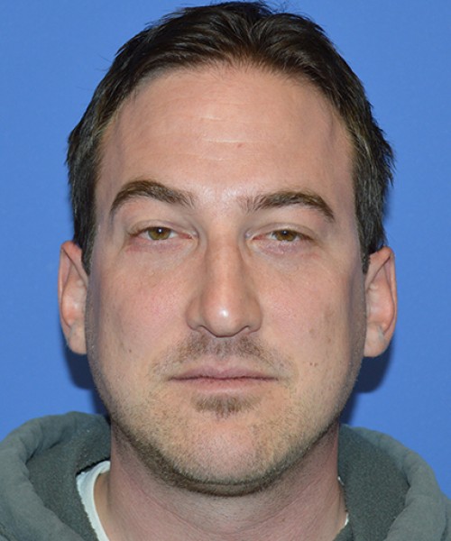 Rhinoplasty 2277 – Click HERE for more views before photo. Individual results may vary.