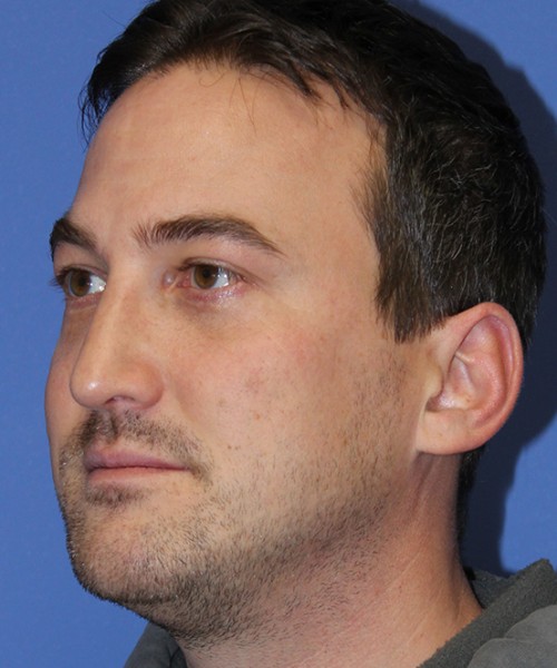 Rhinoplasty 2277 – Click HERE for more views after photo. Individual results may vary.