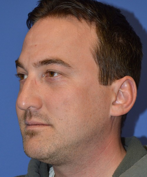Rhinoplasty 2277 – Click HERE for more views before photo. Individual results may vary.