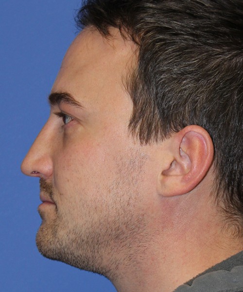 Rhinoplasty 2277 – Click HERE for more views after photo. Individual results may vary.