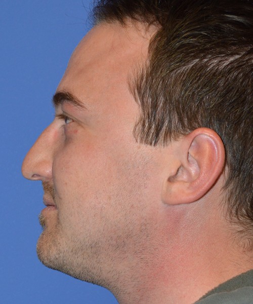 Rhinoplasty 2277 – Click HERE for more views before photo. Individual results may vary.