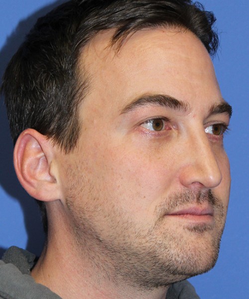 Rhinoplasty 2277 – Click HERE for more views after photo. Individual results may vary.