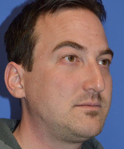 Rhinoplasty 2277 – Click HERE for more views before photo. Individual results may vary.