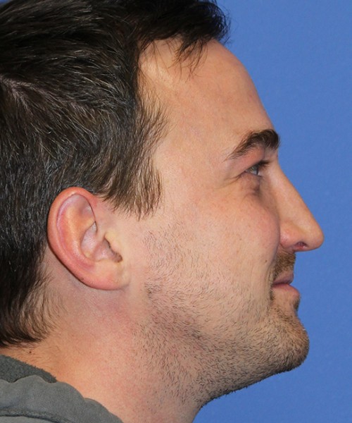Rhinoplasty 2277 – Click HERE for more views after photo. Individual results may vary.