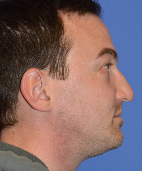 Rhinoplasty 2277 – Click HERE for more views before photo. Individual results may vary.