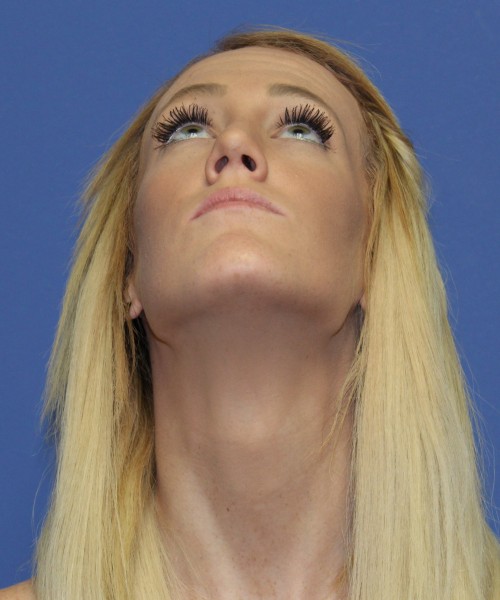 Rhinoplasty 2307 – Click HERE for more views after photo. Individual results may vary.