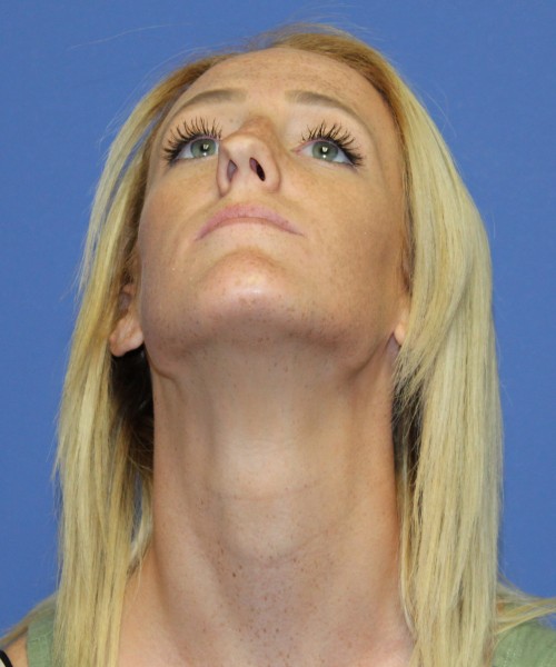 Rhinoplasty 2307 – Click HERE for more views before photo. Individual results may vary.