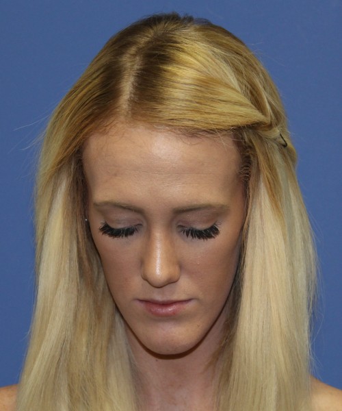 Rhinoplasty 2307 – Click HERE for more views after photo. Individual results may vary.