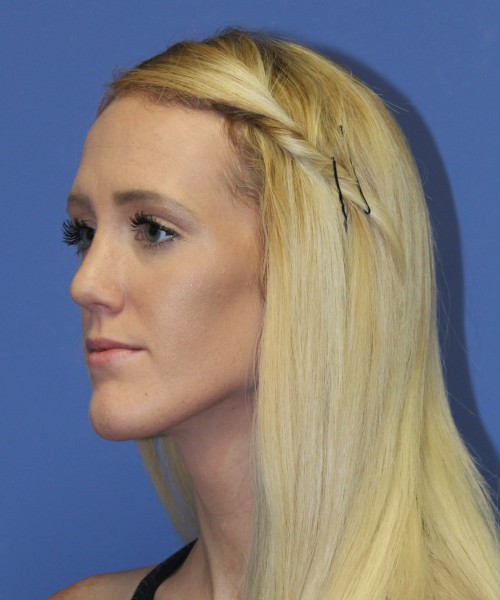 Rhinoplasty 2307 – Click HERE for more views after photo. Individual results may vary.