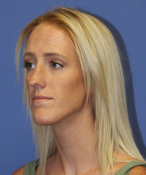 Rhinoplasty 2307 – Click HERE for more views before photo. Individual results may vary.