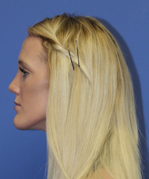 Rhinoplasty 2307 – Click HERE for more views after photo. Individual results may vary.