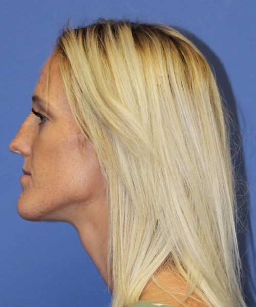 Rhinoplasty 2307 – Click HERE for more views before photo. Individual results may vary.