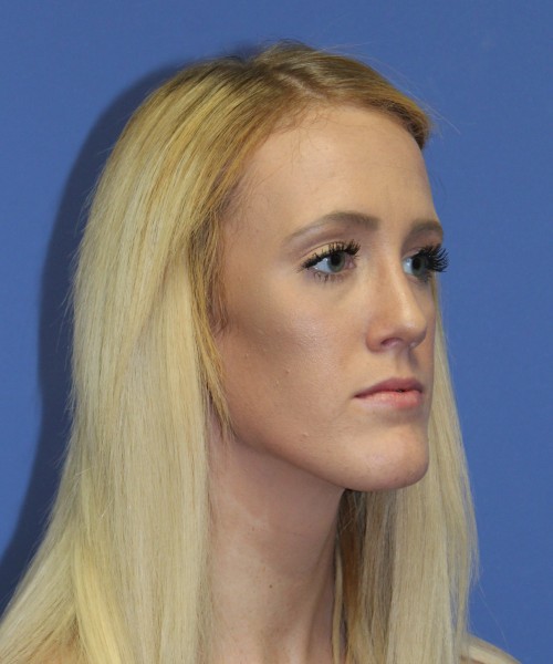Rhinoplasty 2307 – Click HERE for more views after photo. Individual results may vary.