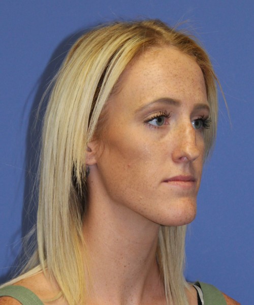 Rhinoplasty 2307 – Click HERE for more views before photo. Individual results may vary.
