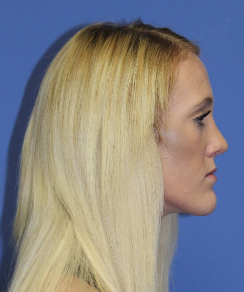 Rhinoplasty 2307 – Click HERE for more views after photo. Individual results may vary.