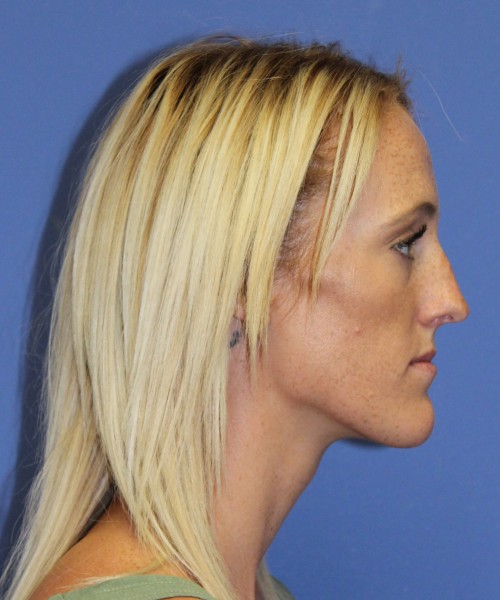 Rhinoplasty 2307 – Click HERE for more views before photo. Individual results may vary.