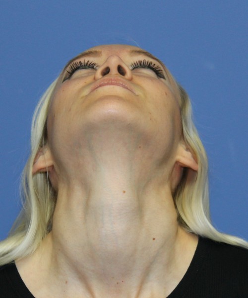 Rhinoplasty 2352 – Click HERE for more views after photo. Individual results may vary.