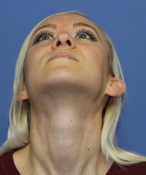 Rhinoplasty 2352 – Click HERE for more views before photo. Individual results may vary.