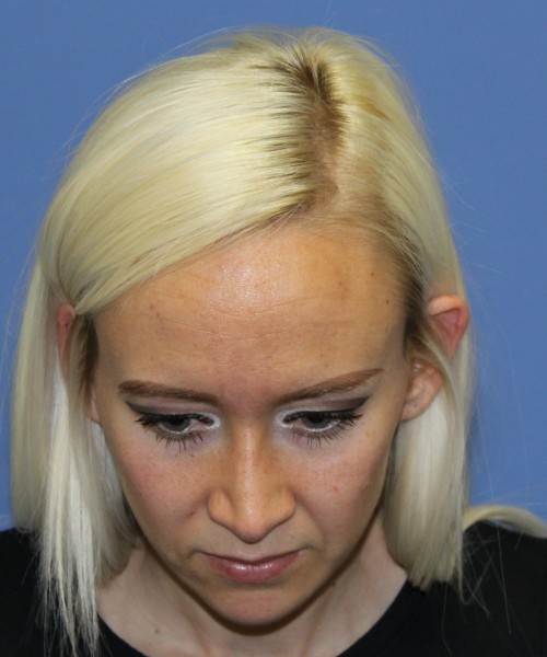 Rhinoplasty 2352 – Click HERE for more views after photo. Individual results may vary.