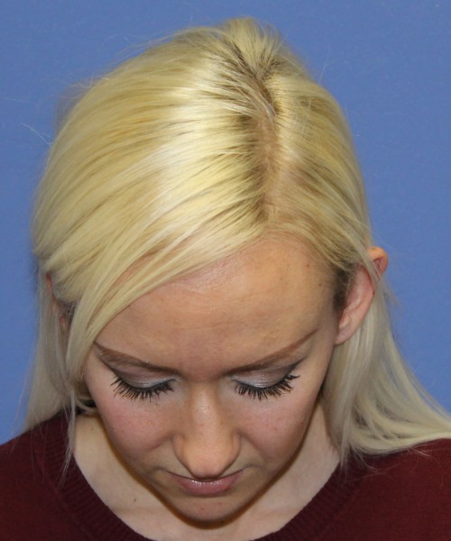 Rhinoplasty 2352 – Click HERE for more views before photo. Individual results may vary.