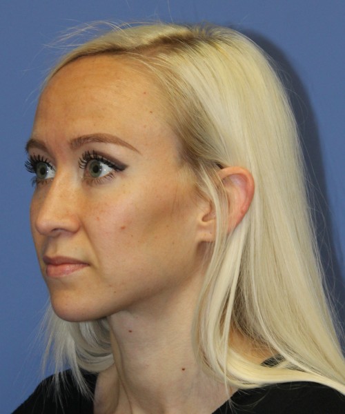 Rhinoplasty 2352 – Click HERE for more views after photo. Individual results may vary.