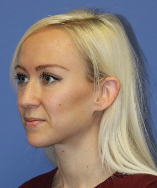 Rhinoplasty 2352 – Click HERE for more views before photo. Individual results may vary.