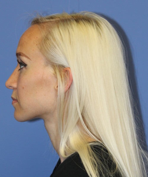 Rhinoplasty 2352 – Click HERE for more views after photo. Individual results may vary.
