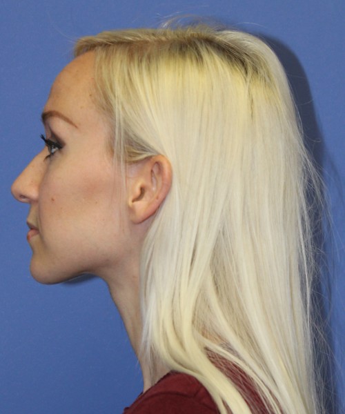 Rhinoplasty 2352 – Click HERE for more views before photo. Individual results may vary.