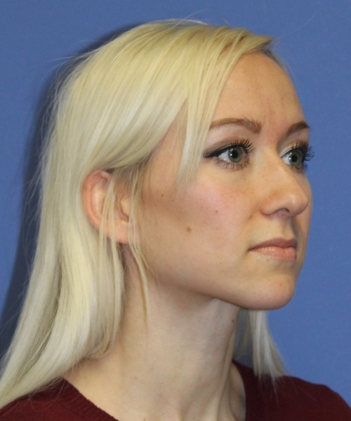 Rhinoplasty 2352 – Click HERE for more views before photo. Individual results may vary.