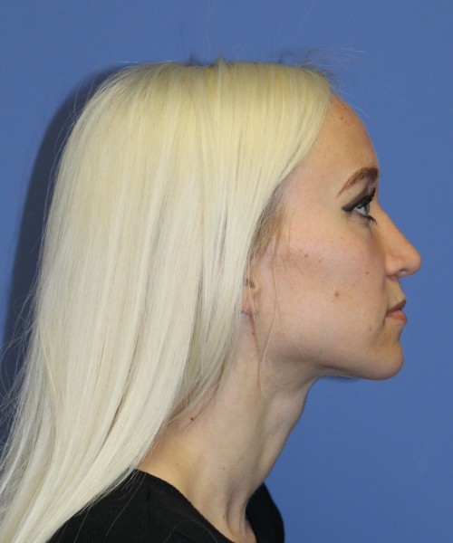 Rhinoplasty 2352 – Click HERE for more views after photo. Individual results may vary.