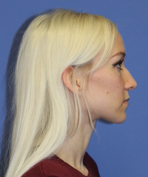 Rhinoplasty 2352 – Click HERE for more views before photo. Individual results may vary.