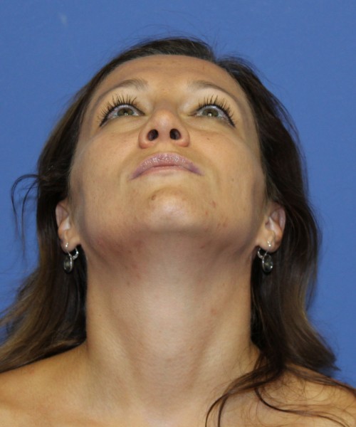 Rhinoplasty 2367 – Click HERE for more views after photo. Individual results may vary.